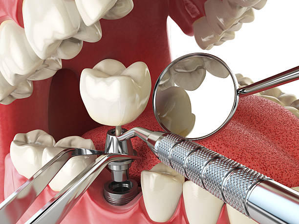 Best Emergency Tooth Extraction in Aloha, OR